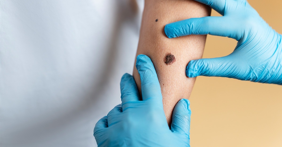 Melanom – koji su rizici za pojavu melanoma i kako se zaštititi?