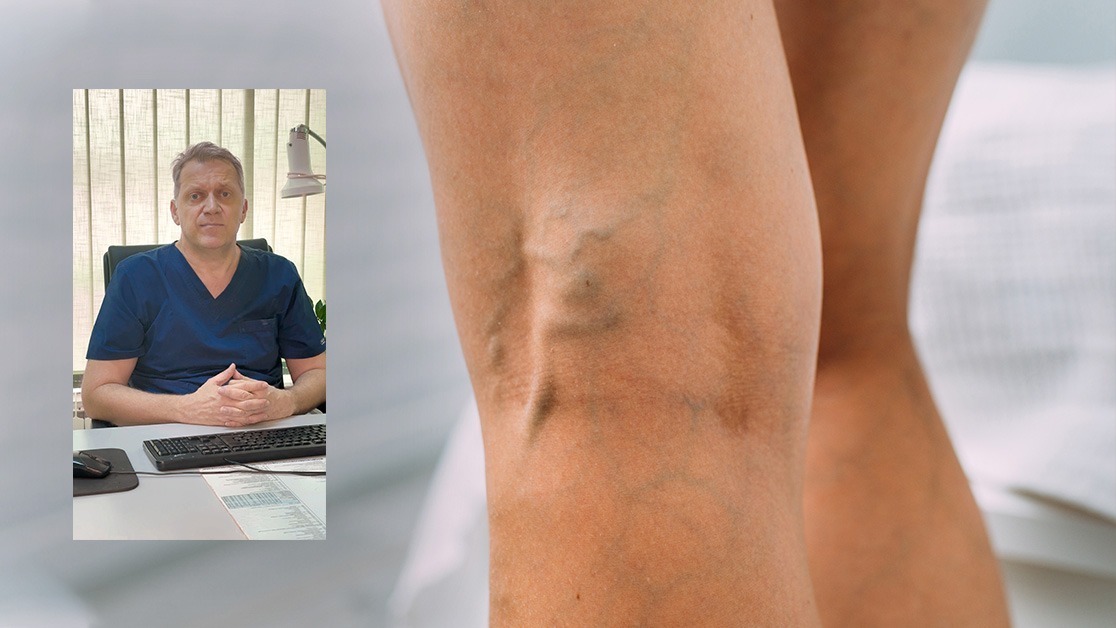 Dr Dario Jocić: Lasersko liječenje proširenih vena